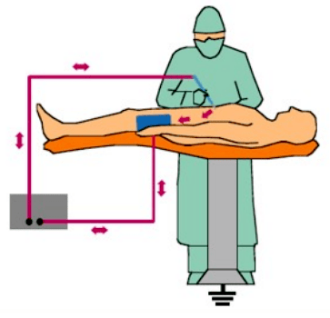 高頻手術示意圖 高頻手術示意圖