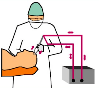 雙相性心衰手術示意圖 雙相性心衰手術示意圖